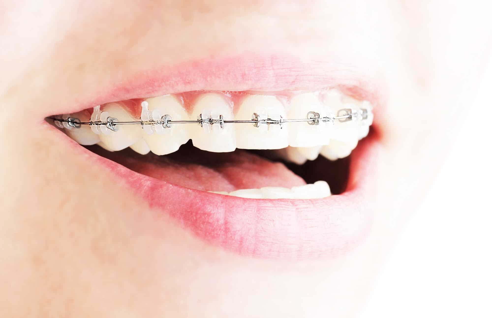 Clear Braces Guide Information on Types, Costs and More in the UK