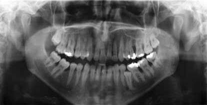 radiographie machoire