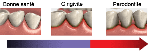 L'évolution de la parodontite
