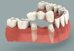 prothèse dentaire : le bridge