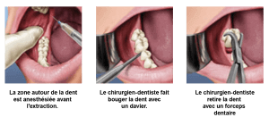 L'extraction dentaire en détails