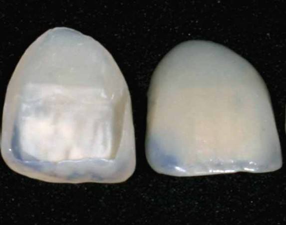 Diastema: Zahnlücke schließen - auch ohne Zahnspange möglich