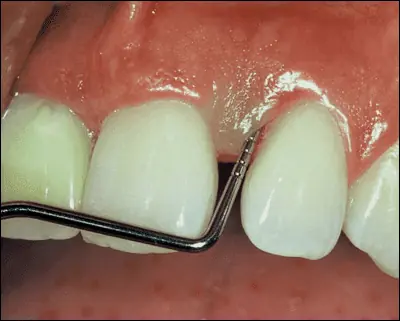 Parodontosebehandlung durch den Zahnarzt mit einem Werkzeug am entzündeten Zahnfleisch