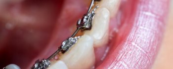 braces behind teeth