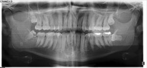 Panoramaschichtaufnahme, auch Orthopantomogramm (OPG) genannt