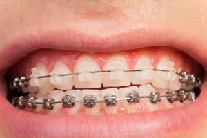 In der Kieferorthopäde für Kinder sind hellere Brackets modern geworden.