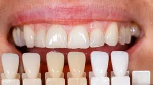 Veneers in verschiedenen Zahnfarben