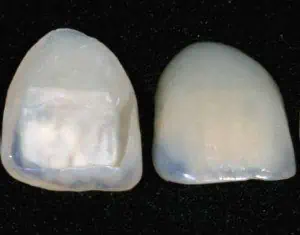 Schiefe Zähne korrigieren mit Veneers
