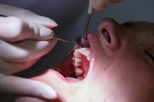 Zahnfleischtaschenmessung