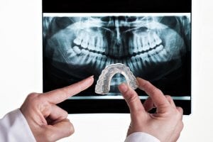 Röntgenfoto und Zahnschiene