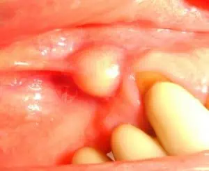 Schwellung durch Eiterbeule im Mund. Die Abszess Ursache sollte schnellstens gefunden werden.