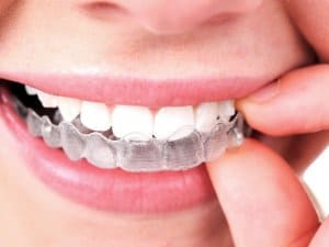 Alignersysteme wie Invisalign sind fortschrittlich