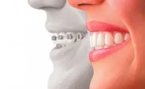 Zahnspange versus Zahnschiene