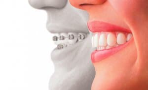 Invisalign Schienen ist kaum sichtbar