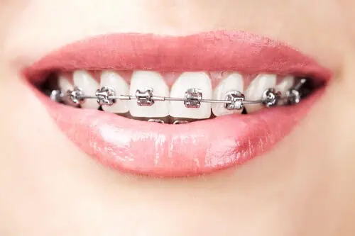 Zahnspange aus Metall