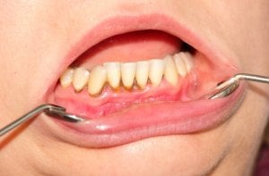 Bei dieser Gingivitis zeigt der Zahnarzt die Zahnfleischentzündung