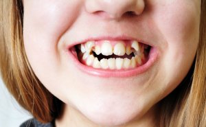 Zahnfehlstellung bei einem Kind