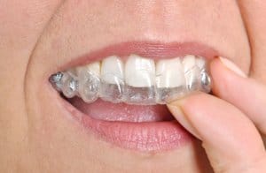 Schienen von Invisalign sind effektiv, wenn man sie trägt.