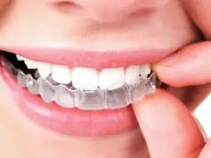 Die Aligner von Invisalign sind einfach besser als andere Spangen