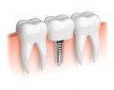 Vergünstigte Implantate durch Zahnzusatzversicherung