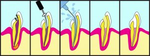 Behandlung der Pulpitis mit Wurzelkanalbehandlung