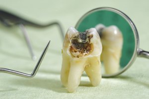 Ursachen für eine Zahnnerventzündung