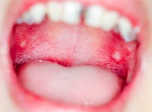 Mundschleimhautentzündung durch Herpes Virus oder Mundfäule