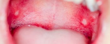 Mundschleimhautentzündung durch Herpes Virus oder Mundfäule