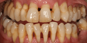 Freilegende Zahnhälse durch Parodontitis