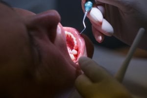 Zahnstein entfernen beim Zahnarzt