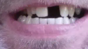 Lächeln mit Zahnlücke