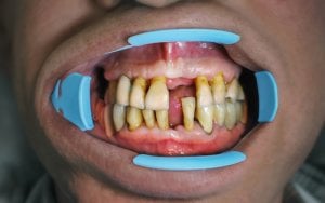 Freiliegende Zahnhälse