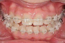Zahnfehlstellung mit Zahnspange behandeln