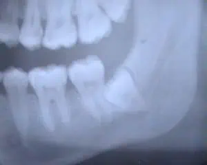 was passiert wenn man die weisheitszähne nicht ziehen lässt? Die Zähne verschieben sich....