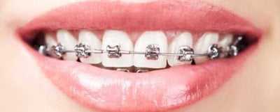 Metallspange zur Behandlung einer Zahnfehlstellung