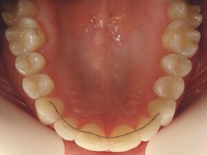 Beinahe unsichtbar ist der Lingualretainer, der aus einem Draht hinter den Zähnen besteht.