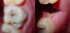 Karies entfernen bevor sie sich durch den Zahn frisst.