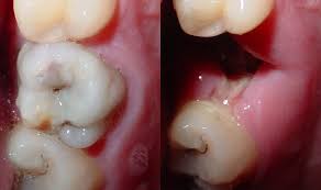 Karies entfernen bevor sie sich durch den Zahn frisst.