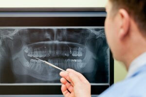 Untersuchung der Zähne mit Panoramaschichtaufnahme