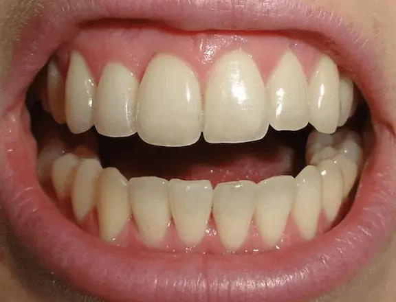 Invisalign vorher/nachher: Erfahrungen mit der unsichtbaren Zahnspange