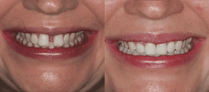 Invisalign vorher/nachher: Erfahrungen mit der unsichtbaren Zahnspange