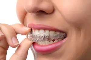 Invisalign unsichtbare Zahnspange