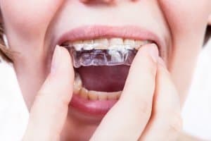 alternativen zu invisalign