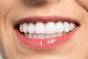 ClearCorrect vs Invisalign