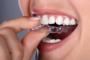 Frau setzt ihre unsichtbare Zahnschiene ein