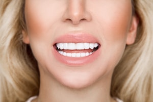 Frau lacht mit weißen geraden Zähnen.