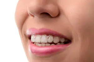 Frau lächelt mit unsichtbarer Zahnspange. 