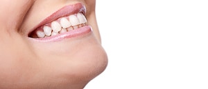 Frau lächelt nach dem Zähne begradigen mit Invisalign
