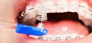 Zähneputzen mit Zahnspange mit Hilfe einer Interdentalbürste