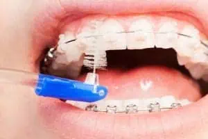 Zähneputzen mit Zahnspange mit Hilfe einer Interdentalbürste